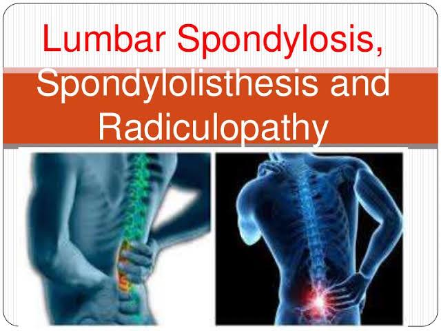 Highly Effective Treatment For Lumbar Spondylosis