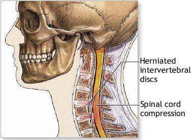 Wonder Treatment For Cervical Spondylosis